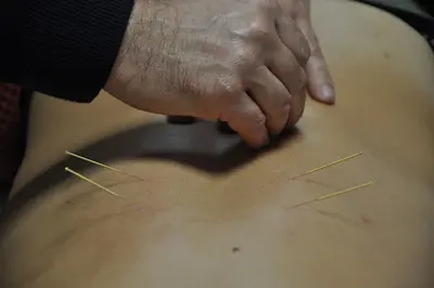 Dr Clément Goubert, Acupuncture, Lot