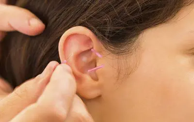 Sylvie Masse. Acupunctrice, Auriculothérapeute.