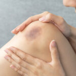 la contusion