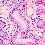 Infection à cytomégalovirus (CMV)