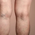 Varices
