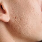 Acné : pourquoi elle persiste et comment retrouver une peau nette ? acné