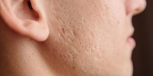 Acné : pourquoi elle persiste et comment retrouver une peau nette ?