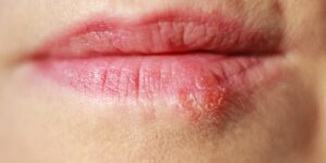 Bouton de fièvre (herpès labial) : comment s’en débarrasser rapidement ?