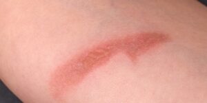 Brûlure : quels sont les bons réflexes pour limiter les cicatrices ?