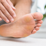 Cors, durillons et œil de perdrix : comment éviter ces douleurs aux pieds ? article-cors-durillon-et-il-de-perdrix-2026-06-11T12-17-20-090Z