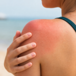 Coup de soleil : pourquoi il est plus dangereux qu’une simple rougeur ? article-coup-de-soleil-2026-06-11T13-12-49-453Z