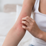 Dermatite atopique (eczéma) : comment calmer les poussées et protéger sa peau ? article-dermatite-atopique-eczema-2026-06-11T13-15-17-442Z