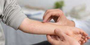 Gale : cette infection parasitaire qui revient en force et comment s’en débarrasser