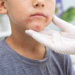 Impétigo : une infection bactérienne fréquente chez les enfants article-impetigo-2026-06-11T13-29-16-940Z