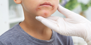 Impétigo : une infection bactérienne fréquente chez les enfants