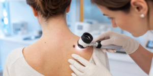 Mélanome (cancer de la peau) : comment repérer une tache suspecte ?