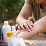 Piqûres d’insectes et morsures d’animaux : quels sont les dangers et comment réagir ? article-piqures-d-insectes-et-morsures-d-animaux-2026-06-11T13-46-13-151Z