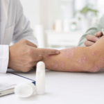 Psoriasis : comprendre cette maladie chronique de la peau et ses traitements article-psoriasis-comprendre-cette-maladie-chron-2026-06-11T13-52-50-669Z