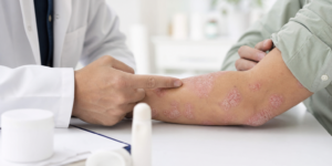 Psoriasis : comprendre cette maladie chronique de la peau et ses traitements