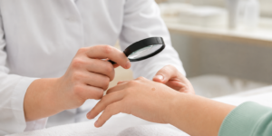Verrue : comment la traiter et éviter qu’elle ne revienne ?